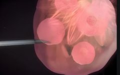 子宫后位是什么情况?会影响试管吗?