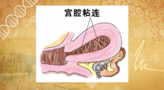 盆腔重度粘连下的试管之路：解锁治疗难关，探寻可行方案