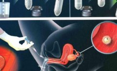 什么是试管取卵?取卵怎么取?