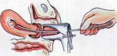 试管攻略——宫腔镜篇