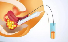 取卵个数不是越多越好，这几大风险女性必知！