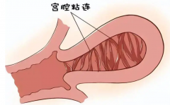 宫腔粘连分离手术不可怕，这些事项要注意！