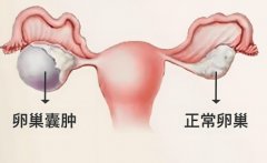 卵巢囊肿要试管怎么办?卵巢囊肿试管需要穿刺吗?
