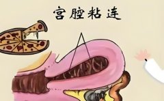 宫腔粘连怎么办?佛山宫腔粘连推荐哪些医院?