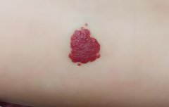 三代试管可以预防血管瘤吗?血管瘤会不会遗传?