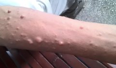 试管可以预防神经纤维瘤吗?能不能阻止神经纤维瘤遗传?