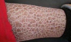 鱼鳞病是什么病?试管可以预防鱼鳞病遗传吗?