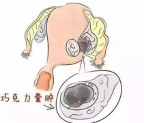 巧克力囊肿对试管成功率的影响深度剖析，关系阐述与潜在影响全知道