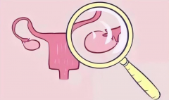 子宫内膜异位症患者的试管之路：影响评估与必知注意事项