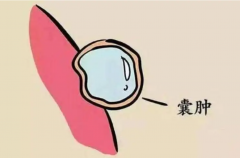 试管与卵巢囊肿：一种微妙的关系揭秘