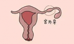 试管也有宫外孕风险！胚胎移位竟是元凶！