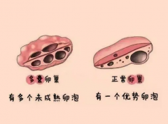 多囊卵巢试管，你真的了解吗？避坑指南，助你成功率翻倍！
