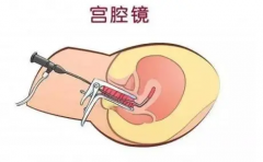 试管宫腔镜检查科普，并非所有人都要做这项检查！