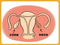 【辟谣】试管不会导致卵巢早衰，这种说法毫无科学依据