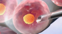 四种常见试管取卵方法，根据个人情况选择！