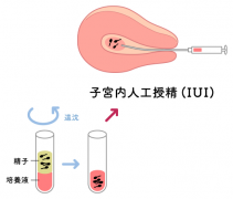 人工授精VS试管：到底哪个更适合你？