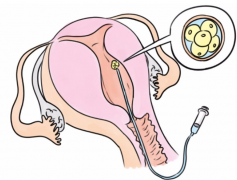 科普试管自然周期取卵，适用于三大人群