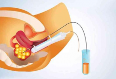试管取卵5大注意事项，每一点都很关键！