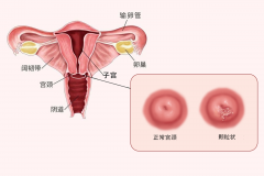 子宫糜烂真的会导致不孕吗？医生告诉你真相！