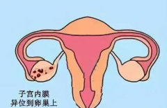 子宫内膜异位症怎么治？从三个方面入手！