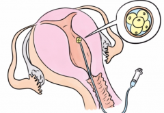 一文读懂试管取卵，要不要请假一看便知！