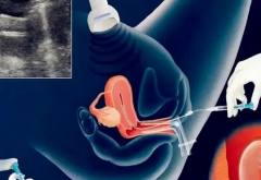 患者分享试管取卵流程，手术前建议看看！