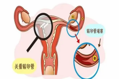 双侧输卵管堵塞不用急，可以尝试试管生育！