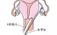 试管取卵手术详细流程，小手术无需担心！