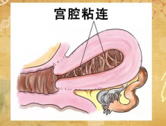 患者分享！宫腔粘连手术后也能成功做试管婴儿！