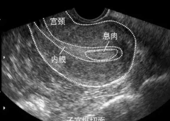 子宫内膜回声不均一定要注意，可能导致试管移植失败！