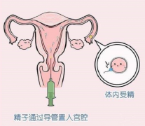 人工授精可以生'男'孩，也需注意还有这些风险在