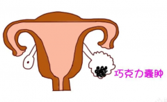 有巧克力囊肿要早治疗，否则可能引起不孕！