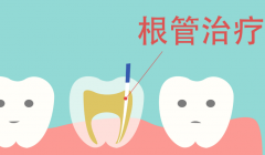 根管治疗可以在移植前做吗？医生建议是先做