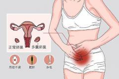 多囊女性做试管婴儿，怀孕几率真有那么低吗？成功率全面解析！