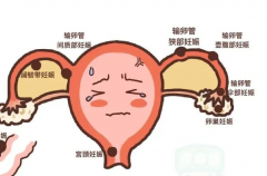发生宫外孕还能做试管婴儿吗？有没有风险？