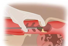 一分钟读懂人工授精，怎么做看这篇