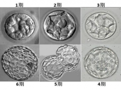 试管婴儿治疗中，哪些情况适合优先培养囊胚？有这4种情况的优先养囊！