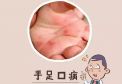 五个原因容易引起手足口病，家长一定要注意了！