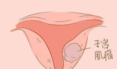 子宫肌瘤也能做试管婴儿，成功率有多少赶紧了解下！