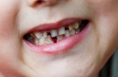 孩子长患龋齿的四大原因，家长一定要注意保护孩子牙齿！