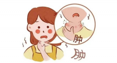 女性如果患上甲亢，会有哪些最为显著的症状表现？全面了解甲亢在女性身上的典型信号！