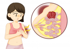 患有乳腺结节三类的女性，能否进行试管婴儿治疗？全面解析乳腺结节与试管婴儿的关系！