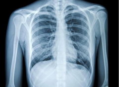 试管为什么要拍胸片？一文为你科普！