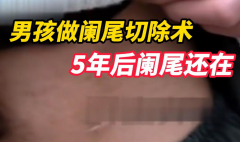 做了阑尾切除手术几年了孩子一直肚子痛，检查发现真相！