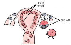 子宫内膜异位症做试管成功率并不低，不必担心怀孕问题！