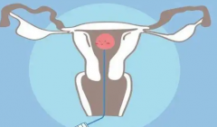 桂林南溪山医院做人工授精大概需要多少费用，详细询问帮您了解价格