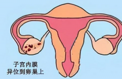 子宫内膜异位症做试管成功率高，专家解析原因！