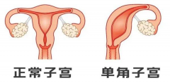 单角子宫能做试管吗？多少费用可以搞定？
