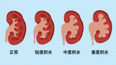 女性要警惕肾积水，盘点肾积水症状和危害！