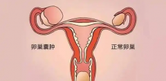 女性卵巢囊肿对怀孕有什么影响？应该怎么治疗？